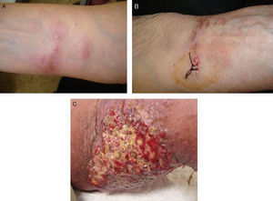 A, Initial presentation of the lesion on the flexor aspect of the forearm. Pliable, erythematous-violaceous plaques with poorly defined borders are shown. B, Lesion on the forearm during the fourth recurrence 3 years before development of the most recent lesion. This lesion is indurated and brownish, and the borders of the erythematous plaque are poorly defined. C, Lesion on the right thigh during the recurrence 6 months before the most recently developed lesion. The multinodular tumor is superficial and ulcerated and has a fleshy appearance.