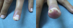 Nodular lesion in the distal subungual region of the fourth finger of the left hand.