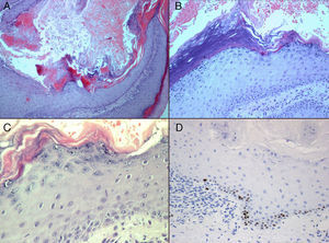 A, Crater filled with amorphous keratin (hematoxylin-eosin, original magnification ×40). B, Epidermal hyperkeratosis, foci of parakeratosis (hematoxylin-eosin, original magnification ×100). C, Dyskeratotic cells with little nuclear atypia (hematoxylin-eosin, original magnification ×400). D, Positive staining for Ki-67 in the stratum basale.