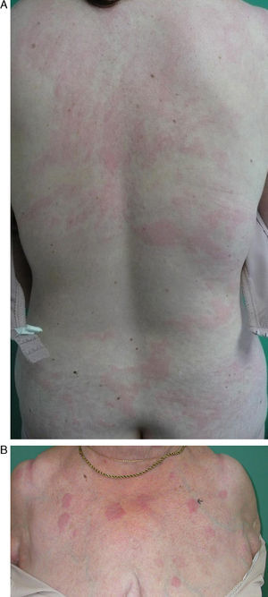 A, multiple partially confluent wheals with a circinate configuration on the back of a woman with acute urticaria. B, erythematous, edematous plaques that are well-defined, oval in shape, somewhat infiltrated, with no epidermal involvement.