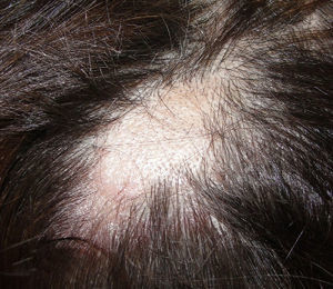 Clinical image of an alopecic plaque in the left parietal region.