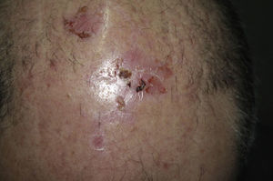 Blistering, erosive lesions on the scalp.