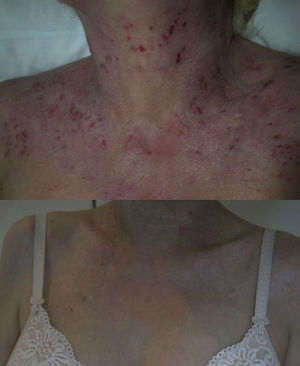 Clinical image of one of our patients before and after treatment with omalizumab in monotherapy (lower image: 2 months after starting treatment).