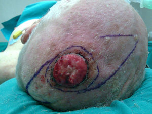 Squamous cell carcinoma of 4cm in diameter on the scalp. The area of excision and the design of the hatchet flaps are outlined.