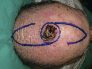 Squamous cell carcinoma of 3cm in diameter on the scalp. The area of excision and the design of the hatchet flaps are outlined.