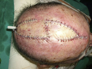 Immediate postoperative result after the excision of a squamous cell carcinoma of the scalp with reconstruction using a double hatchet flap.