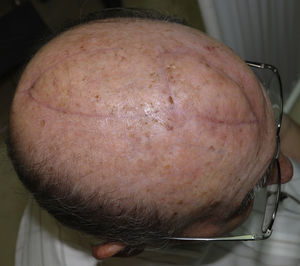 Postoperative result 2 months after reconstruction of the defect with a double hatchet flap.
