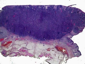 Poorly differentiated nodular squamous cell carcinoma of the skin (hematoxylin-eosin, original magnification ×10).
