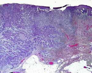 Cutaneous squamous cell carcinoma that has invaded the deep dermis and hypodermis; Clark level IV (hematoxylin-eosin, original magnification ×10).