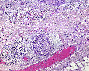 Cutaneous squamous cell carcinoma around a nerve sheath. Perineural invasion is clearly visible (hematoxylin-eosin, original magnification ×100).