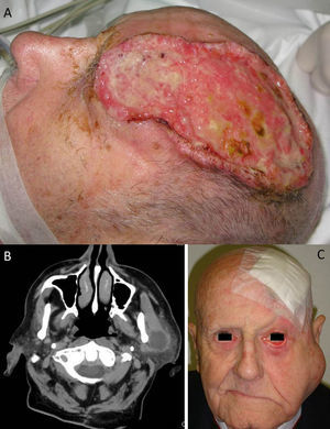 A, Large cutaneous squamous cell carcinoma located in the left frontoparietal region. This tumor has several high-risk features, including its size, its depth, a Clark level of IV (periosteal invasion), and poor differentiation. B, Computed tomography scan of the same patient showing parotid metastases. C, Photograph of the same patient following surgical treatment of the tumor, showing ipsilateral parotid metastases and facial paralysis resulting from tumoral invasion of cranial nerve VII.
