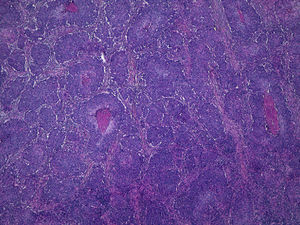 Poorly differentiated cutaneous squamous cell carcinoma. Tumor cell nests with central necrosis can be seen in some areas (hematoxylin-eosin, original magnification ×40).