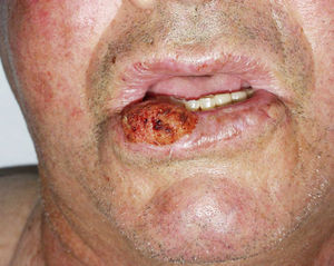 Cutaneous squamous cell carcinoma on the lower lip. This location is considered to be a high-risk feature and has been included in the most recent staging criteria published by the American Joint Committee on Cancer.