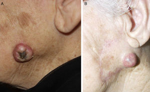 A, Cutaneous squamous cell carcinoma on the cheek. B, Scar left by excision of the tumor and a macroscopically evident enlarged lymph node in the drainage region of the tumor, with associated parotid metastasis, which worsens prognosis.