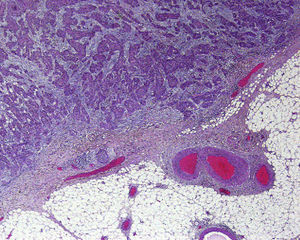 Cutaneous squamous cell carcinoma in which several high-risk features—including moderate-to-poor histological differentiation, deep invasion (Clark level IV), and perineural invasion of a nerve sheath—can be observed microscopically (hematoxylin-eosin, original magnification ×20).