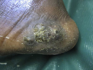 Hyperkeratotic plaque consisting of confluent papules that have a central brown spot.