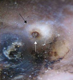 Dermoscopy shows a brown ring around a central pore, surrounded by a whitish halo.