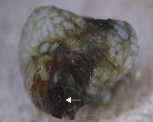 Image of the flea following extraction. Dermoscopy shows a large number of eggs in the abdominal cavity of the flea.