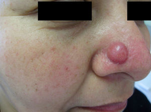 Erythematous nodule on the right ala of the nose.