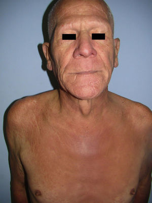 Alopecia universalis and infiltration on the face, especially above the eyebrows, giving the patient a leonine appearance.