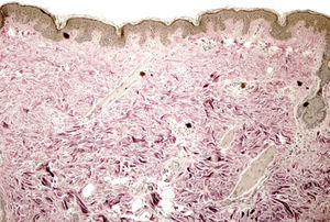 Histopathology with staining of elastic fibers (van Gieson, original magnification ×10). Note the significant reduction in elastic fibers.
