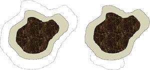 Depiction of differences in the defect left after conventional surgery (left) and after Mohs surgery (right) The dark central area denotes the lentigo maligna melanoma. The more lightly tinted area shows the standard margin (e.g., 0.5cm) of healthy skin removed from around the tumor. The dotted lines indicate the margin that would be taken in a second stage if tumor cells had invaded the first margin. In conventional surgery the defect left by the procedure would be greater than in slow Mohs surgery, which only excises tissue adjacent to the area where the first margin was found to have been invaded.
