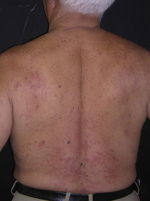 Multiple erythematous papules distributed on the patient's torso; some of the papules have coalesced to form small plaques.
