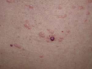 Detail of the lesions, showing millimeter-sized umbilicated papules.