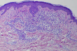 Dense infiltrate in the papillary and middle dermis (hematoxylin-eosin, original magnification ×100).