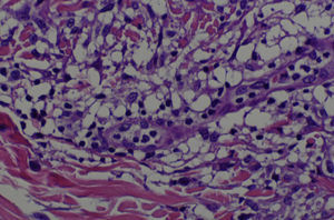 Infiltrate consisting of histiocytes, some of which are vacuolated, lymphocytes, and some multinucleated giant cells (hematoxylin-eosin, original magnification ×250).