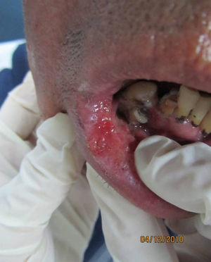 Clinical picture. Multiple spotty erythematous plaques on the lower lip, mulberry-like in appearance.