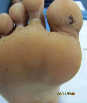 Clinical picture. Small ulcer with smooth borders and a clean base on the plantar surface of the great toe on the right foot.