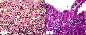 Histopathology. A, Capsule with intense granulomatous reaction (hemoxylin-eosin, original magnification ×10). B, Giant cell containing spores with surface budding (periodic acid-Schiff, original magnification ×40).