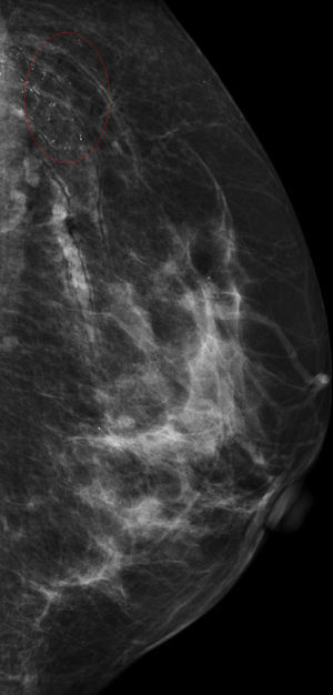 Mammography of the left breast.