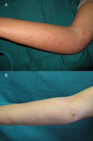 A) Lymphedema and erythematous maculopapular lesions on the inner aspect of the right arm. B) Right arm free of lesions a week after start of treatment.