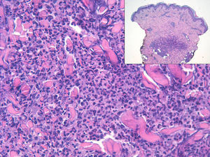 Predominantly perivascular and interstitial inflammatory dermal neutrophilic infiltrate.