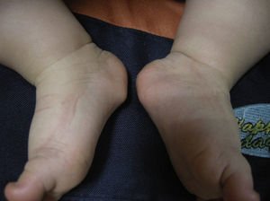 Symmetric nodules on the plantar surface of both feet, just anterior to the heels.