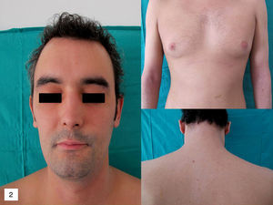 Clinical improvement of our patient after 3 weeks of treatment with oral corticosteroids.