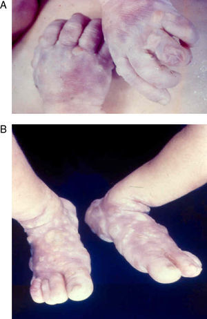 Large highly contagious blisters (syphilitic pemphigus) on the hands (A) and feet (B) of an infant with early congenital syphilis.