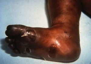 Neonate with coalescing and broken blisters (syphilitic pemphigus) on a foot.