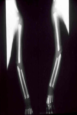 Radiographs showing osteolytic lesions in the proximal and distal metaphyses of the humerus, ulna, and radius bilaterally.