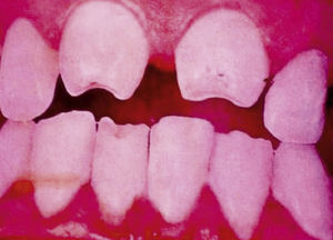 Hutchinson's teeth (notched, peg-shaped incisors) with enamel defects and incipient caries.