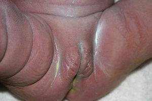 Genital and perianal lesions typical of early congenital syphilis.