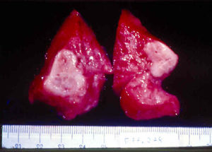 Macroscopic view of the lungs from an infant with late congenital syphilis. The white lesions (gummas) had a firm, elastic consistency.