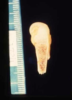 Femur with abnormalities along the epiphyseal line, thickening of the periosteum, and a white nodular area corresponding to a bone marrow gumma.