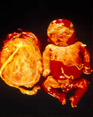 Marked fetal damage and a large, bulky, pale placenta that weighs about a third of the fetal weight.