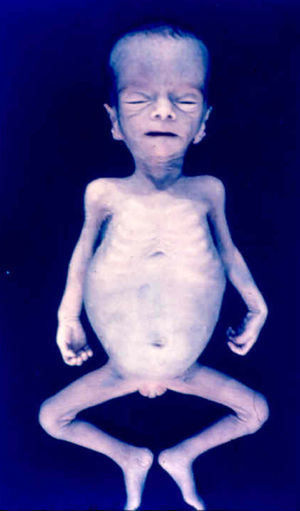 Neonate with severe atrophy and malnutrition (early congenital syphilis).