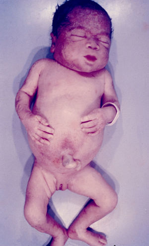 Fetus with myxedema and hypothyroidism.