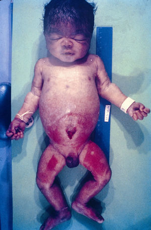 Skin rash and a distended abdomen in a neonate who survived several days with early congenital syphilis.