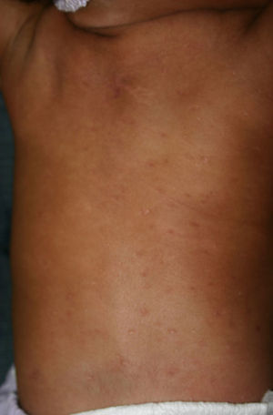 Disseminated erosive papules in an infant with congenital syphilis.